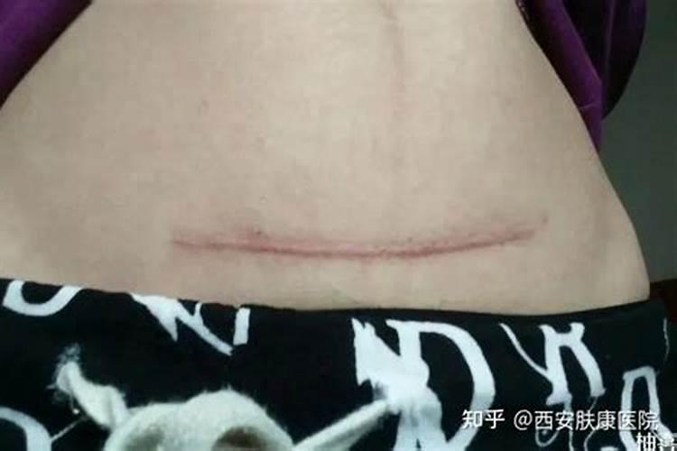 梦见女人肚子上有疤痕是什么意思