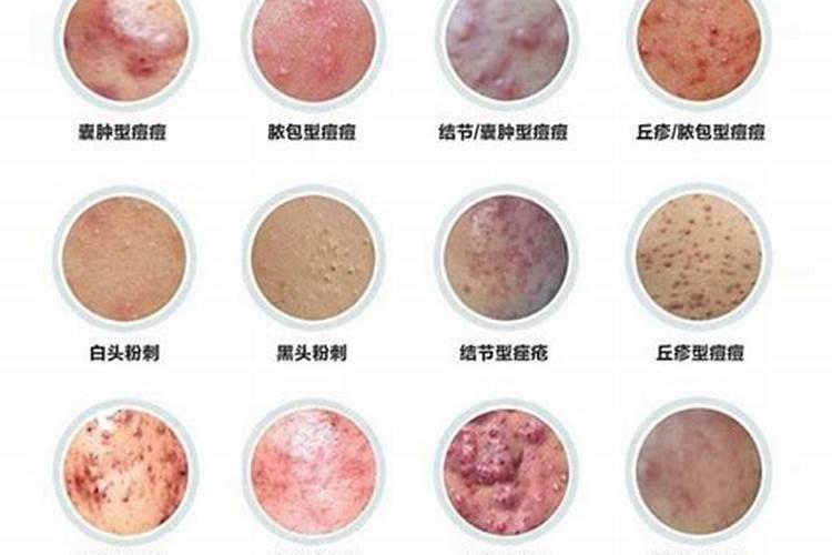 十二生肖中哪个生肖的脸上会长痘痘之类的