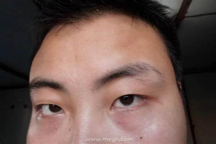 眉毛脱落是什么预兆