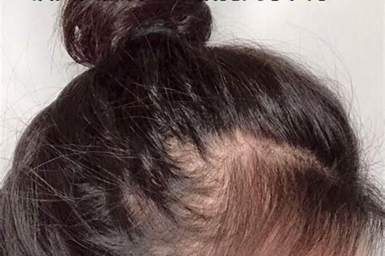 女性做梦掉头发是什么预兆