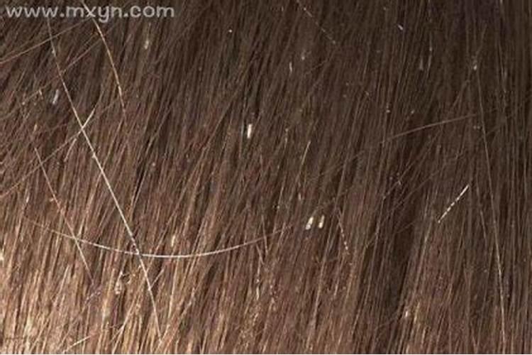 梦见别人头上长虱子是什么意思