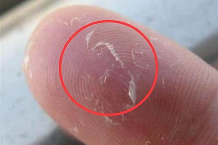 梦见手上有水泡