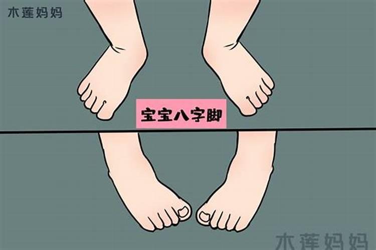 外八字腿是什么