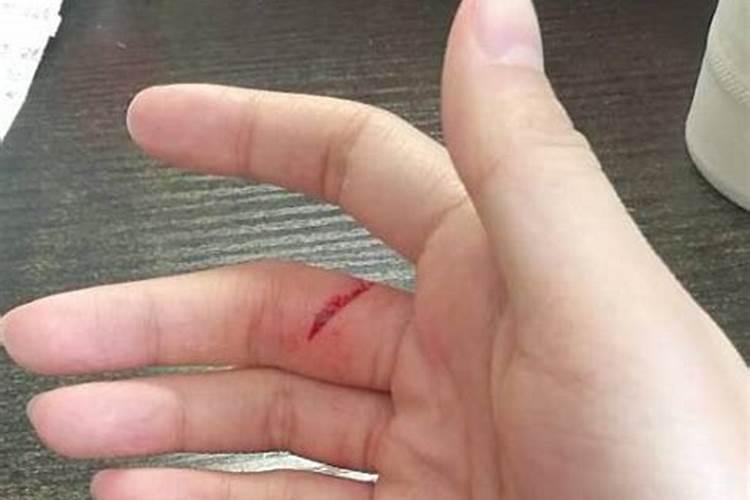 梦到朋友不小心用刀把手给割破了