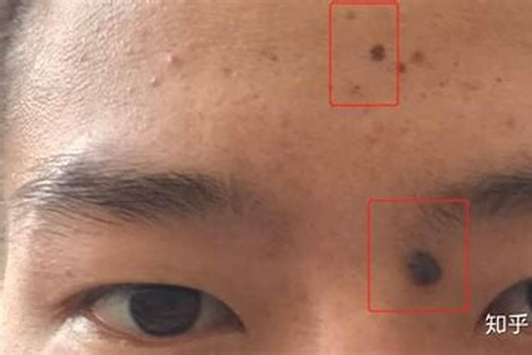 点痣后运气会变吗 不能点的痣？