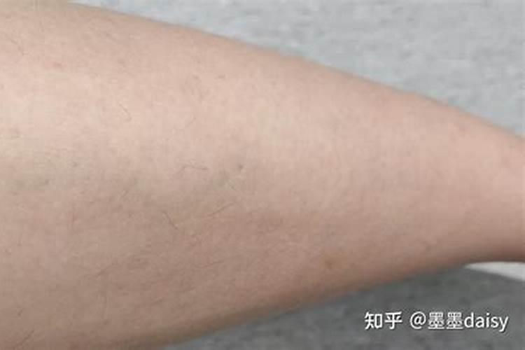 女人痣上长毛是好运吗 女人痣上长毛代表有福气？