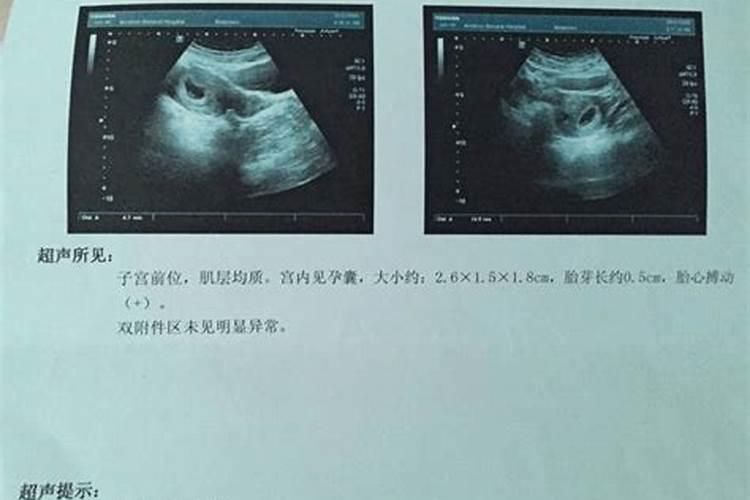 我的女朋友不小心怀孕两个多月了,不想要,请问是什么时候打掉最好...