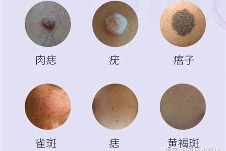 有没有点痣后运气改变的 点痣可以改变命运？
