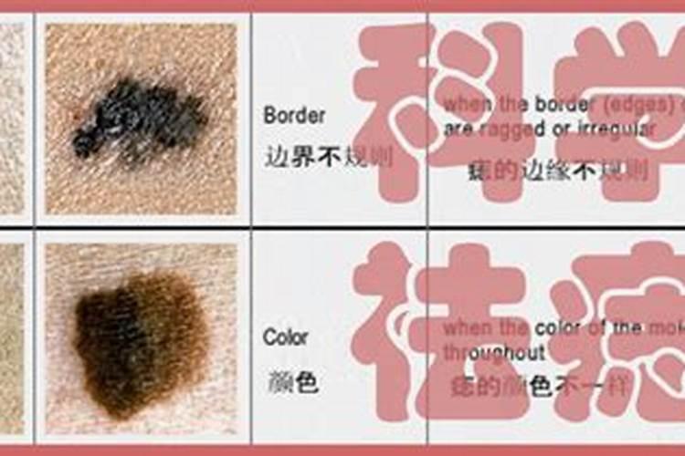痣上长毛的运势解析 事业好财运好？